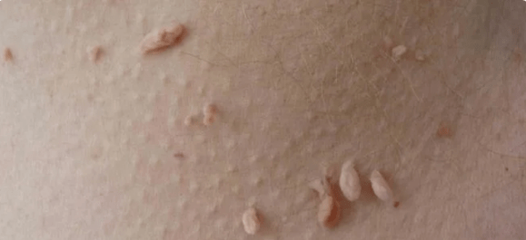 Metoda de transmitere a HPV