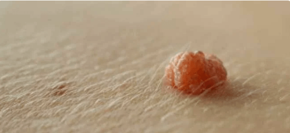 Virusul papiloma