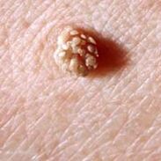 papilomavirus uman pe piele