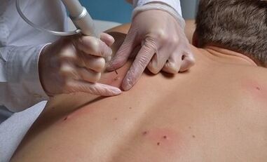 modalități de a elimina papiloamele