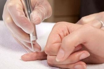 cum să scapi de papiloame de pe corp