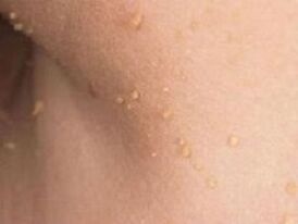 motivele apariției papiloamelor pe corp