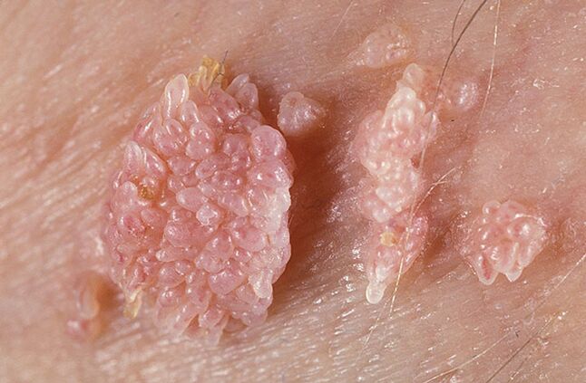 Papilomul este o formațiune benignă asemănătoare unei tumori a pielii și a membranelor mucoase de natură neruoasă